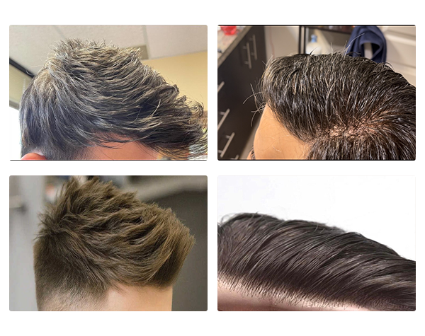 Hair Replacement (6)