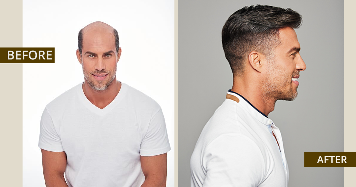 Can a Virtual Hair Replacement System Blend Perfectly With Your Natural Hair?