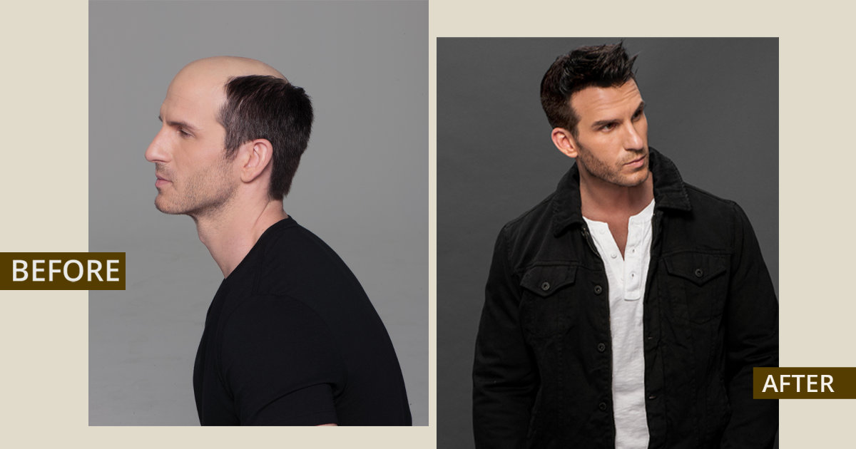 What Are the Benefits of Men’s Non-Surgical Hair Replacement in Yorba Linda?