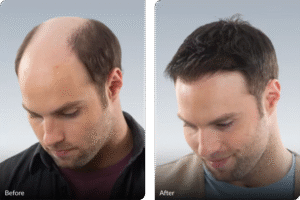 Best Hair System in Lake Forest