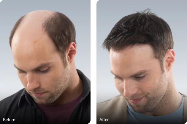 Hair Loss Getting Worse? Here’s Why the Best Hair System in Lake Forest Works